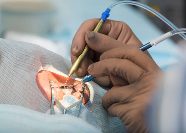 Stitchless Phaco Cataract Surgery